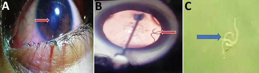 Eosinophilic meningitis and intraocular infection caused by Dirofilaria sp. genotype Hongkong in a patient in Kochi, Inida. A) Organism (arrow) in the left eye of patient during routine clinical examination. The organism caused an abnormal shape of the pupil. B) Live worm (arrow) in anterior chamber of the left eye. This image was obtained while lignocaine was being injected. C) Gross specimen of the worm (arrow) after extraction. Worm is in saline in a Petri dish.