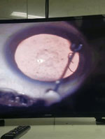Live, mobile worm in anterior chamber of left eye of the patient. Video was taken while lignocaine was being injected. 