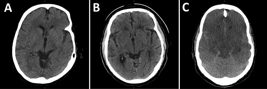 Representative computed tomography axial sections showing early gray-white boundary changes among patients with Eastern equine encephalitis, Connecticut, USA, 2019. A) Axial section showing early gray-white boundary changes on day 3 of illness. B) Axial section with advancing subcortical edema on day 5 of illness. C) Axial section showing diffuse edema with mass effect on adjacent structures and risk of herniation syndromes after 7 days of infection.
