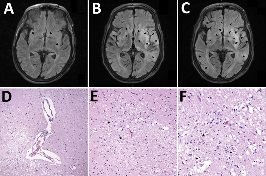 Mechanisms of injury in 4 human cases of Eastern equine encephalitis, Connecticut, USA, 2019. A) Magnetic resonance imaging (MRI) representative axial section from day 2 of a patient’s illness shows early development of edema around the thalamus, basal ganglia, and limbic cortical (arrows) and subcortical (arrowheads) regions. B) Representative MRI axial section from day 4 of a patient’s illness shows progression of injury in these regions and the diencephalon, basal forebrain, and subcortical areas (arrowheads). C) MRI axial section after 1 week of a patient’s illness shows expanding patchy and confluent cortical edema (arrows) and diffuse swelling in basal regions (arrowheads). D) Hematoxylin and eosin (HE)–stained photomicrograph shows the gray-white matter interface with perivascular lymphocytic cuffing and hypoxic-ischemic change in adjacent cortex. Original magnification ×40. E) HE-stained photomicrograph shows a recent gray matter microinfarction, including ischemic neurons with red cell change (5-pointed star) and perineuronal vacuolation (4-pointed star). Original magnification ×200. F) HE-stained photomicrograph shows details of acute hypoxemic-ischemic change with perineuronal (4-pointed stars) and nonspecific vacuolation, red neurons (5-pointed star), rarefaction, and pyknotic cellular debris. Original magnification ×400.