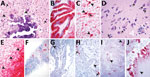 Histologic lesions and porcine morbillivirus (PoMV) RNA in situ hybridization (ISH, red) of tissue of infected swine. A) Histologic section of cerebrum from fetus A stained by hematoxylin and eosin. Arrowheads indicate neuronal necrosis; arrows indicate mineralization and viral inclusion bodies in a neuron and glial cell. B) Cerebellum of fetus A with extensive detection of PoMV by ISH. C) Cerebrum of fetus A; arrowheads indicate ISH labeling within the cytoplasmic and nuclear compartment of neurons; arrow indicates ISH labelling in an axon. D) Cerebrum of fetus B; arrows indicate multiple viral inclusion bodies in neurons; inset displays satellitosis. E) Cerebrum of fetus B showing extensive PoMV detection by ISH. Arrowheads indicate the border of white and gray matter. F) Detection of PoMV by ISH in the spleen of fetus C. G) Detection of PoMV by ISH in a placenta from litter D; arrowhead indicates allantoic epithelium. H) Detection of PoMV by ISH in a renal vessel of a fetus from litter D; arrows indicate the endothelium and arrowhead indicates the vessel lumen. I) Detection of PoMV by ISH in conducting airways (arrowheads) and alveolar septa in the lung of fetus from litter E. J) Detection of PoMV by ISH in the allantoic connective tissue of the placenta and leukocytes from litter F; arrowhead indicates infiltration of leukocytes.
