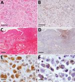 Necrotic foci in the liver and lung from fatal cases of severe fever with thrombocytopenia syndrome (SFTS) in cats, Japan. A, B) Hematoxylin & eosin (HE)–stained (A) and immunohistochemistry-stained (B) liver sections demonstrating SFTS virus–positive blastic lymphocytes in the necrotic foci. Scale bars indicate 100 μm. C, D) HE-stained (C) and immunohistochemistry-stained (D) lung sections demonstrating lymphocytes in the necrotic foci from the lungs. Scale bars indicates 200 μm. E, F) Ki67 (E) and Ig lambda chain (F) immunohistochemistry positively staining blastic lymphocytes. Scale bars indicates 10 μm. 