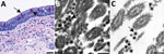 Use of immunohistochemistry and electron microscopy to detect severe acute respiratory syndrome coronavirus 2 (SARS-CoV-2) in formalin-fixed paraffin embedded (FFPE) autopsy tissues. A) Immunostaining (arrows) of SARS-CoV-2 in the epithelial cells of the trachea. Scale bar indicates 20 µm. B) Ultrastructural features of extracellular SARS-CoV-2 particles (arrow) in association with ciliated cells of the trachea from paraffin section in panel A, prepared using an FFPE on-slide method. Scale bar indicates 200 nm. C) Thin section of a biopsy punch from the original FFPE block in panel A showing viral particles (arrow) ≈75 nm. Scale bar indicates 200 nm.