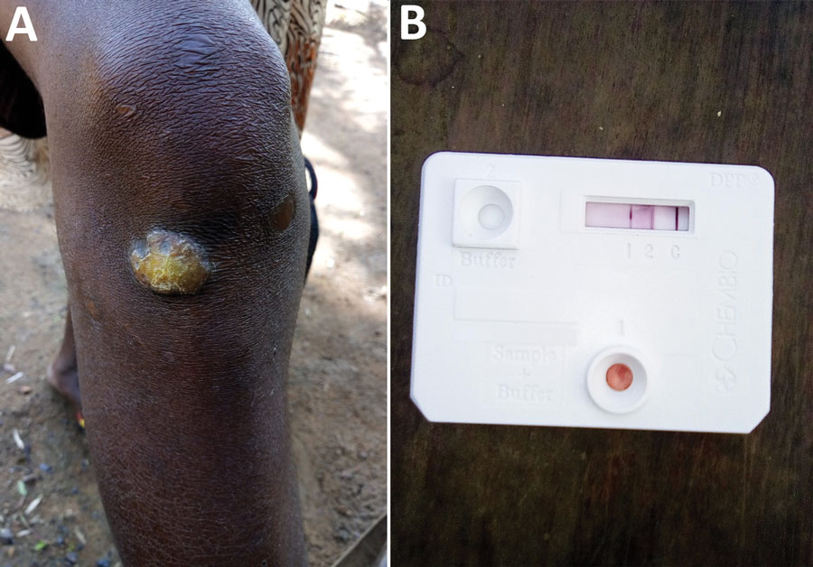 Clinical presentation and serological results of the first confirmed case of yaws since the 1970s and first whole Treponema pallidum subspecies pertenue (TPE) genome from Liberia. A) Papillomatous yaws lesion below the right knee. B) Paired serological results from this case. Dual path platform syphilis lateral flow assay (ChemBio, https://chembio.com) shows antibody binding to treponemal and nontreponemal antigen indicative of active yaws infection. A complete genome sequence was recovered from this case (Figure 3).