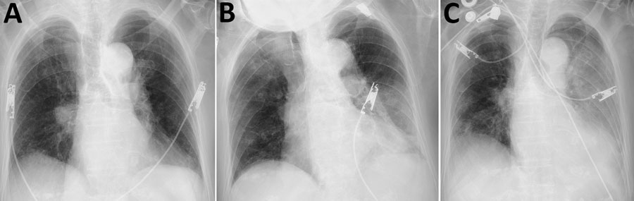 Chest radiographs (anteroposterior views) of hospitalized patient with coronavirus disease and fatal superimposed hypervirulent Klebsiella pneumoniae K2 sequence type 86 infection, Japan, 2020.  A) Hospitalization day 1 (admission), showing no ground glass opacity and consolidation. B) Hospitalization day 7, showing asymmetric infiltrates with pleural effusion, mainly in left lung. C) Hospitalization day 8, showing infiltrate spread to right lower lung and worsened pleural effusion in left lung.