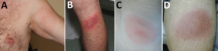 Erythema migrans skin lesions from patients in Europe (A, B) and the United States (C, D).