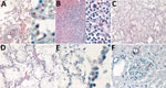 Histopathologic and immunohistochemical characteristics of fatal hantavirus pulmonary syndrome in 2 patients, Arizona, USA, 2020. A) Patient 1 lung tissue, showing intravascular leukocytosis with left shift (left, original magnification ×50) and hantavirus antigen immunostaining (red) in pulmonary microvasculature (right, original magnification ×158). B) Patient 1 spleen tissue, showing immunoblast proliferation in the red pulp and periarteriolar sheaths (left, original magnification ×50) and immunoblasts with high nuclear to cytoplasmic ratio, vesicular and prominent nucleoli (arrows) and mitosis (arrowhead) (right, original magnification ×158). C) Patient 2 lung tissue, showing severe intraalveolar edema (original magnification ×12.5). D) Patient 2 lung tissue, showing interstitial pneumonitis with hyaline membranes (arrows) (original magnification ×50). E) Patient 2 lung tissue, showing hantavirus antigen immunostaining (red) in pulmonary microvasculature (left, original magnification ×50; right, original magnification ×158). F) Patient 2 kidney tissue, showing hantavirus antigen immunostaining (red) in glomerular capillaries (arrowhead) and interstitial vessel (arrow) (original magnification ×100).