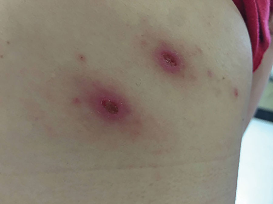 Tick bite sites identified on the right upper back of a 48-year-old woman from the municipality of Dzemul in northeastern Yucatan, Mexico. The woman received a diagnosis of rickettsiosis caused by Rickettsia parkeri strain Atlantic Rainforest.