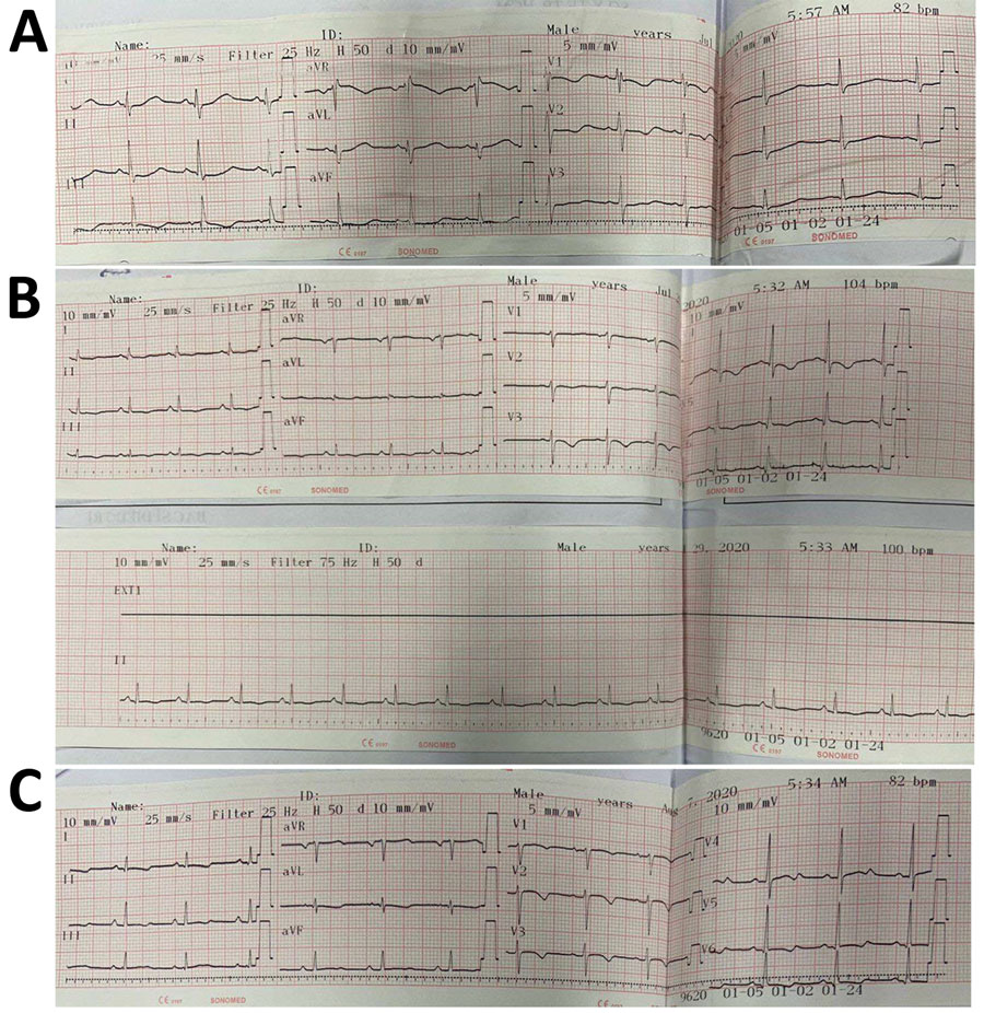 Results of 12-lead electrocardiograms conducted on a 7-year-old boy later diagnosed with diphtheria myocarditis, Vietnam, 2020. A) At hospital admission (day 10 of illness), electrocardiography showed an incomplete right bundle branch block (RSR) in V1–3 with QRS duration of 92 ms), QTc prolongation (519 ms), and ST depression. B) On day 14 of illness, we observed sinus tachycardia with occasional supraventricular premature complexes and T-wave inversion. C) On day 25, we observed widespread T-wave inversion, which persisted even after clinical recovery.