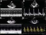 Serial echocardiographic recordings for 7-year-old boy later diagnosed with diphtheria myocarditis, Vietnam, 2020. On day 14 of illness, the M-mode left ventricular ejection fraction decreased to 40% (A) and the E/A ratio was >3.5 (B). At 2-week follow-up after discharge, both left ventricular systolic (C) and diastolic function (D) had recovered.