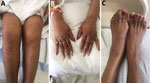 Tender, warm, and swollen knees (A), wrists (B), and left ankle (C) with decreased range of motion in a patient with septic polyarthritis caused by Streptobacillus moniliformis infection, United States.