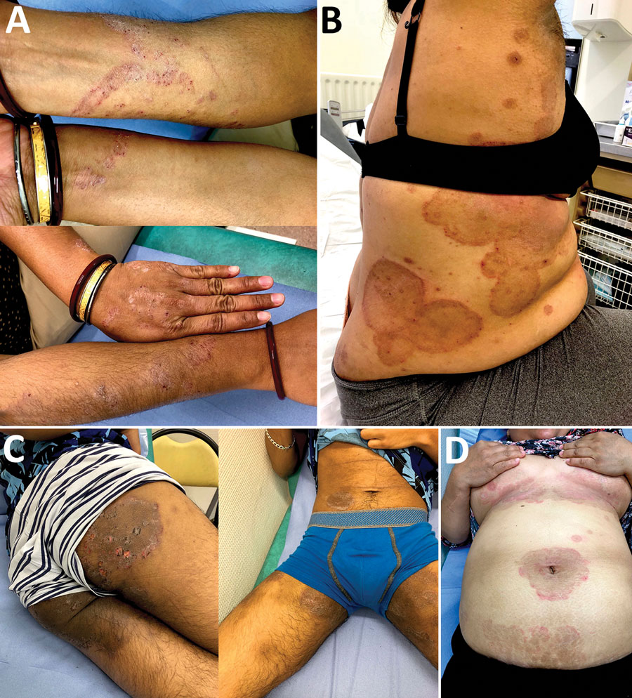 Morphologic features of difficult-to-treat dermatophytosis caused by Trichophyton mentagrophytes complex internal transcribed spacer type VIII (T. indotineae) in patients in Paris, France. A) Scaly plaques with erythema and surrounding papulae and vesicles of the arms (patient 1); B) centrifuge annular erythema of the trunk after topical and oral corticosteroids (patient 6); C) erythematous and scaly plaques (patient 3); D) pruritic cutaneous lesions of the groin and axillary pits to which was applied steroids (patient 5).