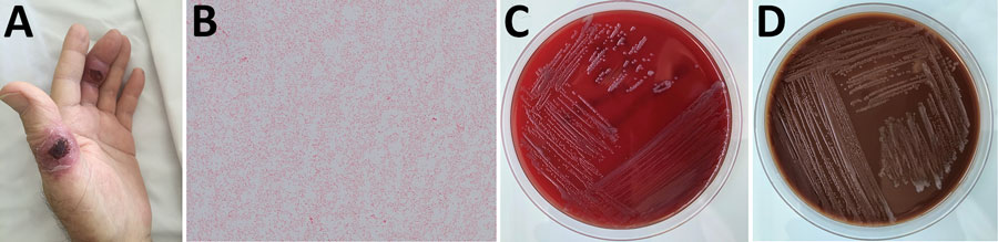 Skin ulcers and bacteremia caused by Francisella salimarina in an immunocompromised patient and isolated bacteria morphology, France. A) Skin lesion on 2 left-hand fingers. B) Small gram-negative coccobacillus isolated from blood and skin lesions (original magnification ×1,000). C) Growth on blood agar after 2 days of incubation at 35°C in 5% CO2. D) Growth on chocolate agar after 2 days of incubation at 35°C in 5% CO2.