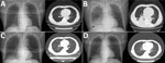 Chest radiography and computed tomography images during acute infection with Legionella pneumophila subspecies fraseri after allogeneic hematopoietic stem cell transplant, China, 2021. A) May 13 (day 104), B) May 17 (day 108), C) May 24 (day 115), D) June 1 (day 123). Arrow in panel B indicates a large, solid, fuzzy shadow with unclear boundary, uneven internal density, and low-density plaques in the lower lobe of the right lung. 