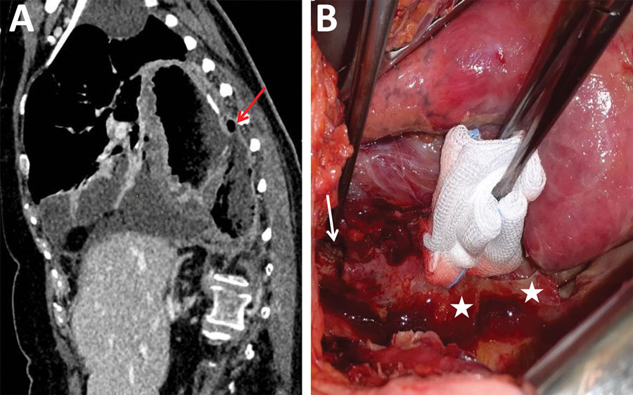 Clinical and radiologic characteristics of mediastinitis caused by Kazachstania bovina (patient 2), Strasbourg, France. A) Computed tomography image demonstrating stomach ulceration (arrow), mediastinitis, and pleuritis. B) Photograph taken after right-side thoracotomy, showing posterior stomach ulceration (arrow) and false membranes (stars). Culture of biopsy samples grew K. bovina, Candida albicans, C. glabrata, and bacteria.