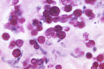 Periodic acid‒Schiff‒stained tissue sample from a case-patient who had protothecosis, showing several sphere-like cells of Prototheca spp. Source: Dr. Jerrold Kaplan, Centers for Disease Control, 1971.