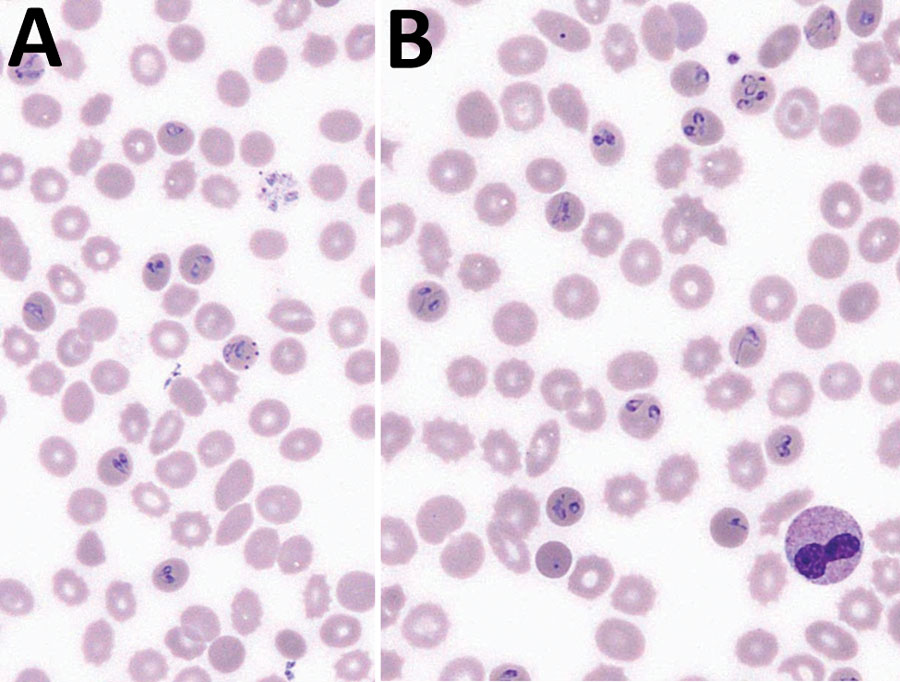 Two representative microscopic fields (original magnification ×1,000) of a May–Grünwald–Giemsa stained blood smear, showing different forms of Babesia trophozoites, from a 61-year-old man from western France.