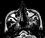 T2-weighted magnetic resonance imaging of the maxillary sinuses of a patient with mucormycosis after coronavirus disease, Pune, India, shows hypointense mucosal thickening bilaterally, more on the left side than the right. Near-complete occlusion of the sinus cavities and obliteration of left osteomeatal unit are seen. There is a mild deviation of the nasal septum with convexity toward the right side. There is mild soft tissue edema with altered signal abnormality involving the left pterygopalatine fossa extending to the left masticator space. L, left; R, right.