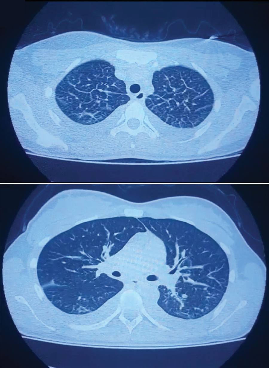Computed tomography scan results on the second day of hospitalization (day 7 after fever onset) for a patient with severe acute respiratory syndrome coronavirus 2 and hantavirus co-infection, Argentina, 2020, showing pleural effusion, interstitial compromise, vascular congestion, and glass-ground opacities. 