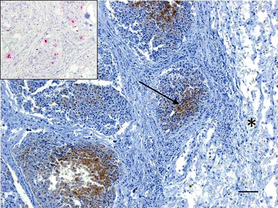 Immunohistochemistry testing for influenza A virus antigen in lung tissue of an adult male harbor seal, British Columbia, Canada. Viral antigen (arrow) was detected by immunohistochemistry within the bronchiolar-associated lymphoid tissue but not in adjacent lung parenchyma (*). Viral RNA could also be detected in bronchiolar-associated lymphoid tissue by in situ hybridization (inset, pink areas). Scale bar = 50 μm.