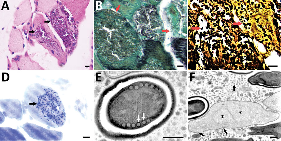 Light microscopy and transmission electron microscopy of left biceps branchii muscle biopsy tissue from a 45-year-old man with microsporidiosis caused by Anncaliia algerae, China. A–D) Light microscopy using different stains. A) Periodic acid-Schiff stain. Scale bar indicates 10 µm. Original magnification ×50. B) Gomori methenamine silver stain. Scale bar indicates 10 µm. Original magnification ×63. C) Warthin-Starry stain. Scale bar indicates 10 µm. Original magnification ×63. D) Toluidine blue stain. Scale bar indicates 10 µm. Arrows indicate myocytes replaced by aggregates of 2–3 µm ovoid organisms. Original magnification ×63. E, F) Transmission electron microscopy showing Anncaliia-like microsporidia. Scale bars indicate 500 nm. E) A mature spore with electron-dense exospore, electron-lucent endospore, and a single row of 6 to 8 polar tubule coils (arrows). Original magnification ×8,000. F) Proliferating form of microsporidia showing diplokaryotic nuclei (stars) with vesiculotubular structures extending from the meront cell membrane and aggregating in the host cell cytoplasm (arrows). Original magnification ×3,000.