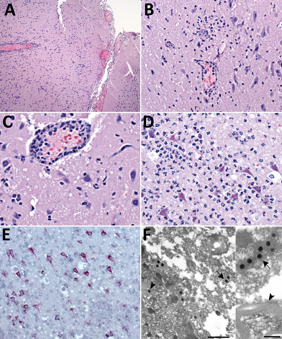 Pathologic changes in brain of free-ranging black-tufted marmosets with fatal human alphaherpesvirus 1 infection, Brazil, 2012–2019. A) Necrotizing meningoencephalitis. Hemotoxylin and eosin (H&E) stain; original magnification ×10. B) Neuronal degeneration and glial nodule. H&E stain; original magnification ×40. C) Neuronal necrosis with microglial proliferation and expansion of Virchow–Robbin spaces by lymphocytes, histiocytes, and few plasma cells. Neurons and glial cells show intranuclear inclusion bodies and prominent margination of the nuclear chromatin. H&E stain; original magnification ×63. D) Prominent neutrophilic inflammation accompanies neuronal necrosis and intranuclear inclusion bodies. H&E stain; original magnification ×63. E) Human alphaherpesvirus 1 immunostaining within neurons (immunohistochemistry; original magnification ×40). F) Intranuclear (arrowhead) and cytoplasmic (arrow) herpesvirus particles in gray matter. Transmission electron microscopy; scale bar indicate 500 nm. Inset: cytoplasmic herpesvirus particles (arrow) white matter, myelinated axon (arrowhead); scale bar indicates 200 nm.