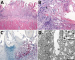 Tongue pathology in free-ranging black-tufted marmosets with fatal human alphaherpesvirus 1 infection, Brazil, 2012–2019. A) Severe necrosis of epithelium. Hemotoxylin and eosin (H&E) stain; original magnification ×10. B) Intranuclear inclusion bodies in epithelial cells at the margin of the lesion and multinucleated syncytial cell (arrow). H&E stain; original magnification ×40. C) Human alphaherpesvirus 1 immunostaining within epithelial cells in the area of necrotizing glossitis. Immunihistochemistry; original magnification ×40. D) Epithelial cell containing accumulations of herpesvirus within the cytoplasm. Transmission electron microscopy; scale bar indicates 600 nm. Inset: higher magnification image of herpesvirus particles with well-defined tegument layer in the cytoplasm; scale bar indicates 400 nm.
