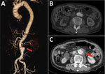 Contrast-enhanced computed tomography imaging for Case-patient 3 in the Helicobacter cinaedi group of 10 patients with infected aortic aneurysms with or without H. cinaedi, Aichi, Japan, September 2017–January 2021. A, B) The infrarenal aortic aneurysm had a maximum short diameter of 39 mm and a cystic protrusion of 19 mm (arrow in panel A) before the operation. C) After the operation, the adipose tissue concentration increased around the aneurysm (arrow).