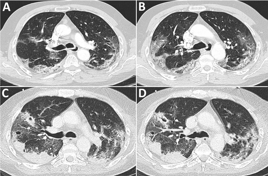 Computed tomography scans of patient with Bordetella hinzii pneumonia and severe respiratory syndrome coronavirus 2 infection. A, B) Scan at admission showing bilateral evidence of extensive areas of mainly crazy paving patterns with some posterior consolidations. C, D) Scan at day 25 showing  marked increased extent of consolidation.