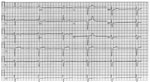 Electrocardiogram of a a 48-year-old patient in Israel with Q fever, showing a complete atrioventricular block with ventricular escape rate of 35 bpm and a QRS duration of 140 ms. 