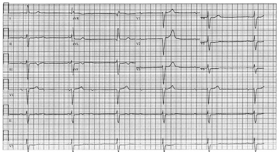 Electrocardiogram of a a 48-year-old patient in Israel with Q fever, showing a complete atrioventricular block with ventricular escape rate of 35 bpm and a QRS duration of 140 ms. 
