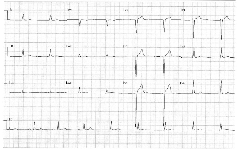 Electrocardiogram of a 23-year-old patient in Israel with Q fever, showing a left bundle branch block with sinus bradycardia of 35 bpm.