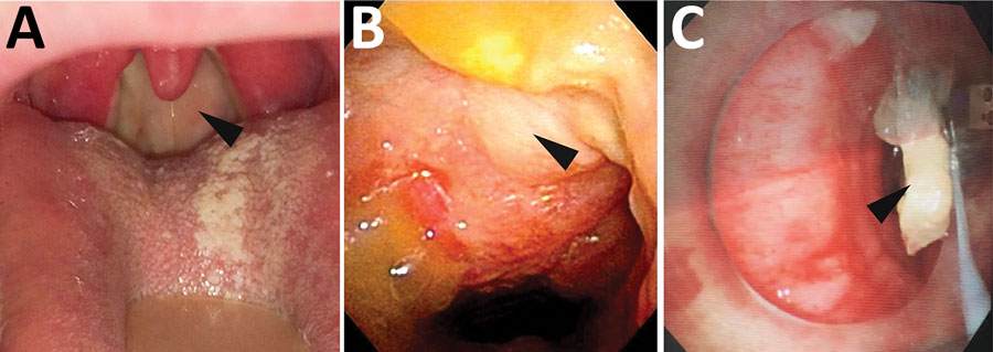 Endoscopic images of the pharynx and bronchi of patients with Corynebacterium ulcerans infection, Japan, 2001–2020. A, B) Posterior wall of the pharynx has a yellowish white pseudomembrane. Arrows indicate the white pseudomembrane attached to the pharynx (case no. 21, from Dr. Toyoshima, Japanese Red Cross Ise Hospital, Mie, Japan). C) Pseudomembrane on the bronchi. Arrows indicate the pseudomembrane attached to the bronchi (case no. 29, from Dr. Hayashi, Maebashi Red Cross Hospital, Gunma, Japan). 