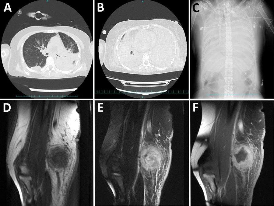 Computed tomography, radiograph, and magnetic resonance imaging results for patients with Corynebacterium ulcerans infection, Japan, 2001–2020. A–C) Chest computed tomography images and radiograph of patients with severe respiratory symptoms. Atelectasis noted at admission (A, top) and after exacerbation of symptoms (B, bottom) (case no. 29, from Dr. Hayashi, Maebashi Red Cross Hospital, Gunma, Japan). Spread of atelectasis noted on chest radiograph taken at the time of exacerbation of symptoms (C) (case no. 29, also from Dr. Hayashi, Maebashi Red Cross Hospital). D–F) Magnetic resonance imaging of an elbow abscess. Magnetic resonance imaging T1-weighted images show equal brightness to the muscles (D), fat-suppressed T2-weighted image by short-tau inversion recovery method show unevenly high brightness (E), and contrast-enhanced T1-weighted images show a mass whose margins are contrast-enhanced (F) (case no. 10, from Dr. Urakawa, Tsuruoka Municipal Shonai Hospital, Yamagata, Japan).