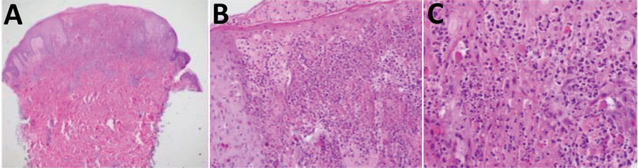 Imported monkeypox from international traveler, Maryland, USA, 2021. A) Epidermal necrosis, reticular necrosis, and vesiculation. In the dermis, a diffuse mixed superficial dermal infiltrate was observed. B, C) Higher magnification views showing dyskeratotic keratinocytes, neutrophil exocytosis, and intracytoplasmic inclusion bodies consistent with Guarnieri bodies in the epidermis. Hematoxylin and eosin stain; original magnification ×4 in panel A, ×20 in panel B, and ×40 in panel C.
