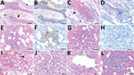 Histopathologic changes and SARS-CoV-2 expression in the upper and lower respiratory tracts of mink experimentally infected with Omicron variant at 7 days postinfection and recipient mink after 10 days of follow-up. A) Respiratory segment of the nose from an intranasally infected mink showing luminal accumulation of exudate (asterisks) and degeneration of mucosal epithelium (arrow) Scale bar indicates 500 µm. B) Viral antigen widely detected within nasal lumen and respiratory epithelium. Scale bar indicates 500 µm. C, D) Respiratory epithelium from a recipient mink depicting marked degeneration and loss (arrow in panel C) and intraluminal accumulation of sloughed cells and neutrophils (asterisk in pane C), and intraepithelial viral expression (panel D). Scale bars indicate 50 µm. E–H) Lungs from intranasally infected (E, F) and recipient (G, H) mink showing alveolar damage with intralesional presence of viral nucleoprotein. Scale bars indicate 200 µm in panels E–G and 50 µm in panel H. I, J) Marked degeneration and necrosis of alveolar septa and focal hyalin membrane (arrow in panel I) and prominent proliferation of type II pneumocytes (panel J) in an intranasally infected mink. Scale bars in indicate 25 µm). K, L) Recipient mink showing bronchiolar epithelial degeneration and hyperplasia (K) and vasculitis (L) with complete destruction of blood vessel wall and mononuclear cell infiltration. Scale bar indicates 50 µm in panel K and 100 µm in panel L. Hematoxylin and esosin stain and immunohistochemistry, hematoxylin counterstain.