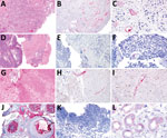 Tissue samples from 3 patients with trichodysplasia spinulosa polyomavirus endothelial infection, California, USA. We performed hematoxylin and eosin (H&E) staining and RNAScope in situ hybridization (ISH) to detect trichodysplasia spinulosa polyomavirus (TSPyV) in formalin-fixed, paraffin-embedded tissue specimens. Bright red, granular staining in endothelium indicates TSPyV RNA. A) Case 1, H&E staining, original magnification ×10; B) case 1, TSPyV ISH, original magnification ×10; C) case 1, TSPyV ISH, original magnification ×40; D) case 2, H&E staining, original magnification ×5; E) case 2, TSPyV ISH, original magnification ×10; F) case 2, TSPyV ISH, original magnification ×40; G) case 3, H&E staining, original magnification ×5; H) case 3, TSPyV ISH, original magnification ×10; I) case 3, TSPyV ISH, original magnification ×40; J) biopsy from patient with cutaneous trichodysplasia spinulosa (positive control), TSPyV ISH, original magnification ×10; K) cutaneous biopsy from patient with Merkel cell polyomavirus-positive Merkel cell carcinoma (negative control), TSPyV ISH, original magnification ×40; L) renal biopsy from patient with BK polyomavirus nephropathy (negative control), TSPyV ISH, original magnification ×60. 