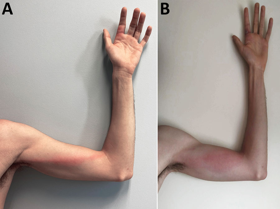 Monkeypox signs in a previously healthy male physician in Portugal after occupational needlestick injury from pustule. A) Tender, indurated, erythematous, and well-delimited linear streak from the left finger to the armpit, on the seventh day of illness. B) Aggravated lymphangitis on the ninth day of illness.