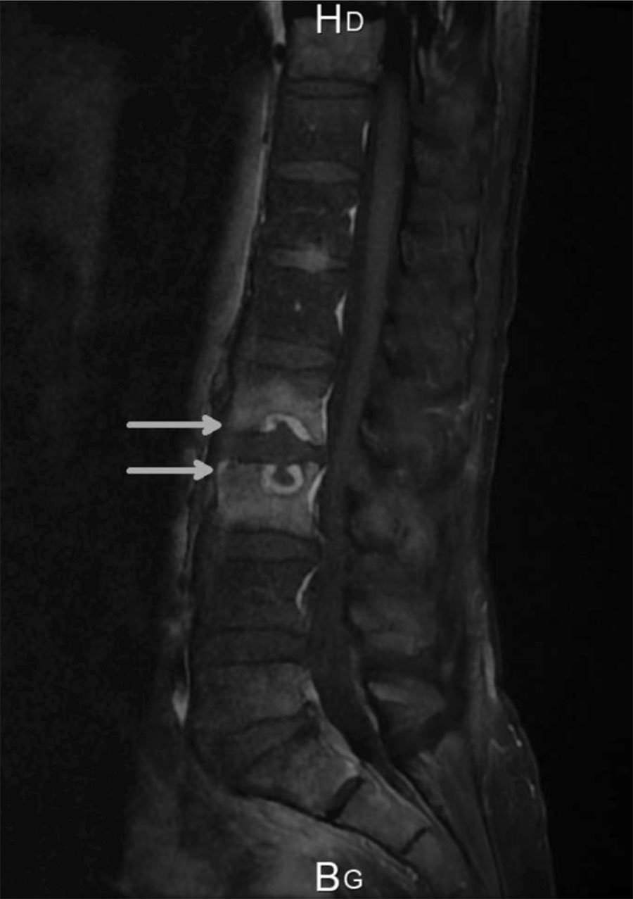 Sagittal gadolinium magnetic resonance image of spine of a patient in France with spondylodiscitis caused by Nocardia neocaledoniensis. Image shows erosion of the cortical end plate of L2 and L3 (arrows).