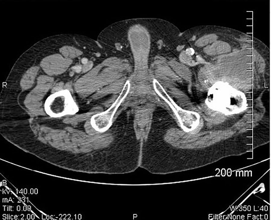 Computed tomography scan of pelvis in case 1 showing large abscess of the left hip with a periosteal image compatible with an osteitis in case of Francisella tularensis–related prosthetic joint infection, France.