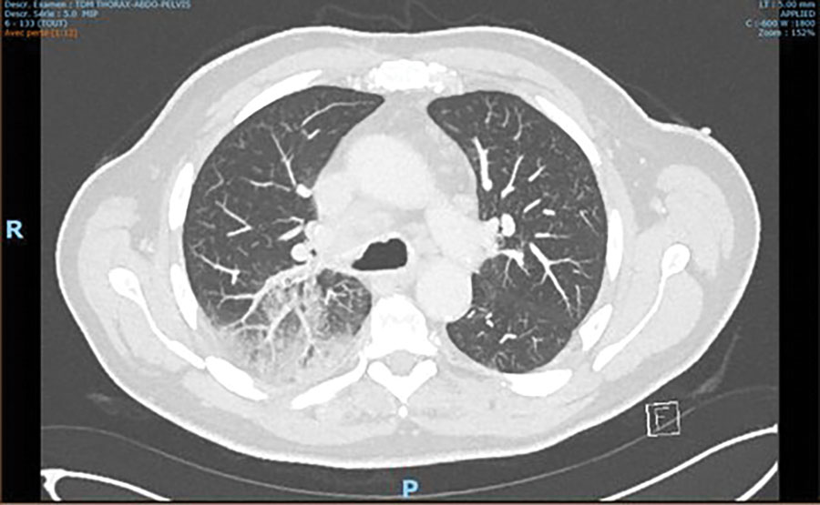 PET scan of the lung in case 2 showing the presence of bilateral mediastinohilar lymphadenopathies associated with a diffuse condensation of the upper right pulmonary lobe in case of Francisella tularensis–related prosthetic joint infection, France.