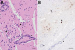 Microscopic analyses of tissue samples from a harbor porpoise (Phocoena phocoena) infected with highly pathogenic avian influenza virus H5N1 clade 2.3.4.4b, Sweden. A) Brain tissue showing neuronal necrosis (arrowheads) and perivascular lymphoplasmacytic cuffing of vessels and vasculitis (asterisk). Scale bar represents 20 µm. B) Immunohistochemical labeling of influenza A nucleoprotein in neuronal nuclei (arrowhead) and cytoplasm (arrow), as well as glial cells. Perivascular cuffing (asterisks) is seen in close association to influenza A immunolabeling. Scale bar represents 100 µm.