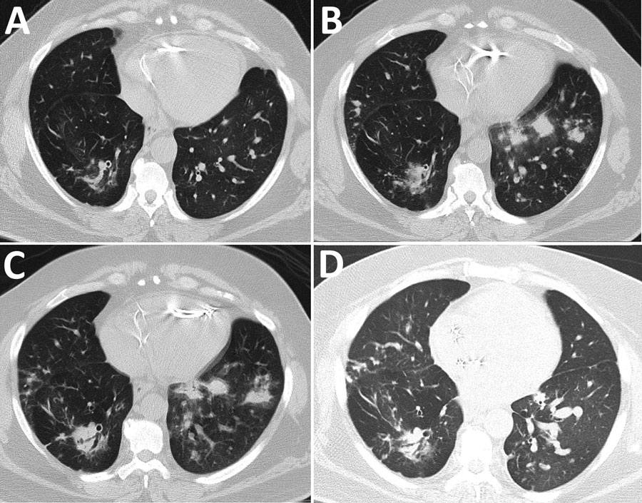 Computed tomography of the chest without contrast showing progression of illness in a 52-year-old immunocompromised man who experienced Nocardia pseudobrasiliensis pneumonia after a SARS-CoV-2 infection. A) Scan obtained 4 months before patient sought care. B) Scan on hospitalization day 5 shows development of lung nodules without ground-glass opacities in both lungs. C) Scan on hospitalization day 12 shows progression of nodules on the left lung. D) Scan obtained 28 days post-discharge shows improvement of pulmonary nodules.