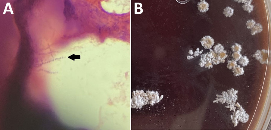 Histopathology of samples from a 52-year-old immunocompromised man who experienced Nocardia pseudobrasiliensis pneumonia after a SARS-CoV-2 infection. A) Branching gram-positive rods (arrow) seen in Gram stain of Nocardia culture plate. Original magnification ×100. B) N. pseudobrasiliensis colonies seen on a Nocardia culture plate with characteristic chalky white and orange pigmentation.