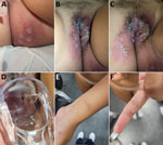 Pustules in gluteal area (A), genital area (B, C), intravaginal area (D), arm and hand (E), and finger (F) in young woman with monkeypox virus infection after sexual intercourse, France, September 2022.