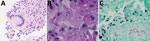 Left lower lobe needle core biopsy histology of Emergomyces pasteurianus infection in a patient returning to the United States from Liberia. A) Numerous yeast within a multinucleated giant cell shown by hematoxylin and eosin stain; original magnification ×600.  B) Narrow budding yeast shown by periodic acid–Schiff stain; original magnification ×1,000. C) Yeast shown by Grocott methenamine sliver stain; range 2–5 μm.