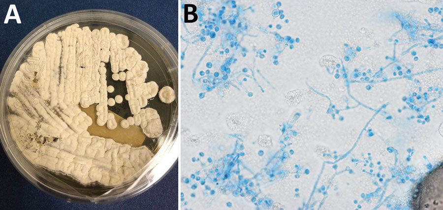 Lung nodule biopsy and fungal culture isolate of Emergomyces pasteurianus infection in a patient returning to the United States from Liberia. A) Colony morphology on Sabouraud dextrose agar at 14 days. B) Lactophenol cotton blue tape prep; original magnification ×1,000.