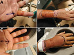 Clinically apparent areas of infection with Globicatella species in patient with soft tissue ianfection after cat bite, United Kingdom: A) left little finger, B) right forearm, C) right middle finger, and D) right hand.
