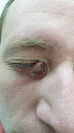 Cutaneous lesion caused by Leishmania infantum on the right lower eyelid of a patient seen at Chaim Sheba Medical Center, Israel, 2021. 