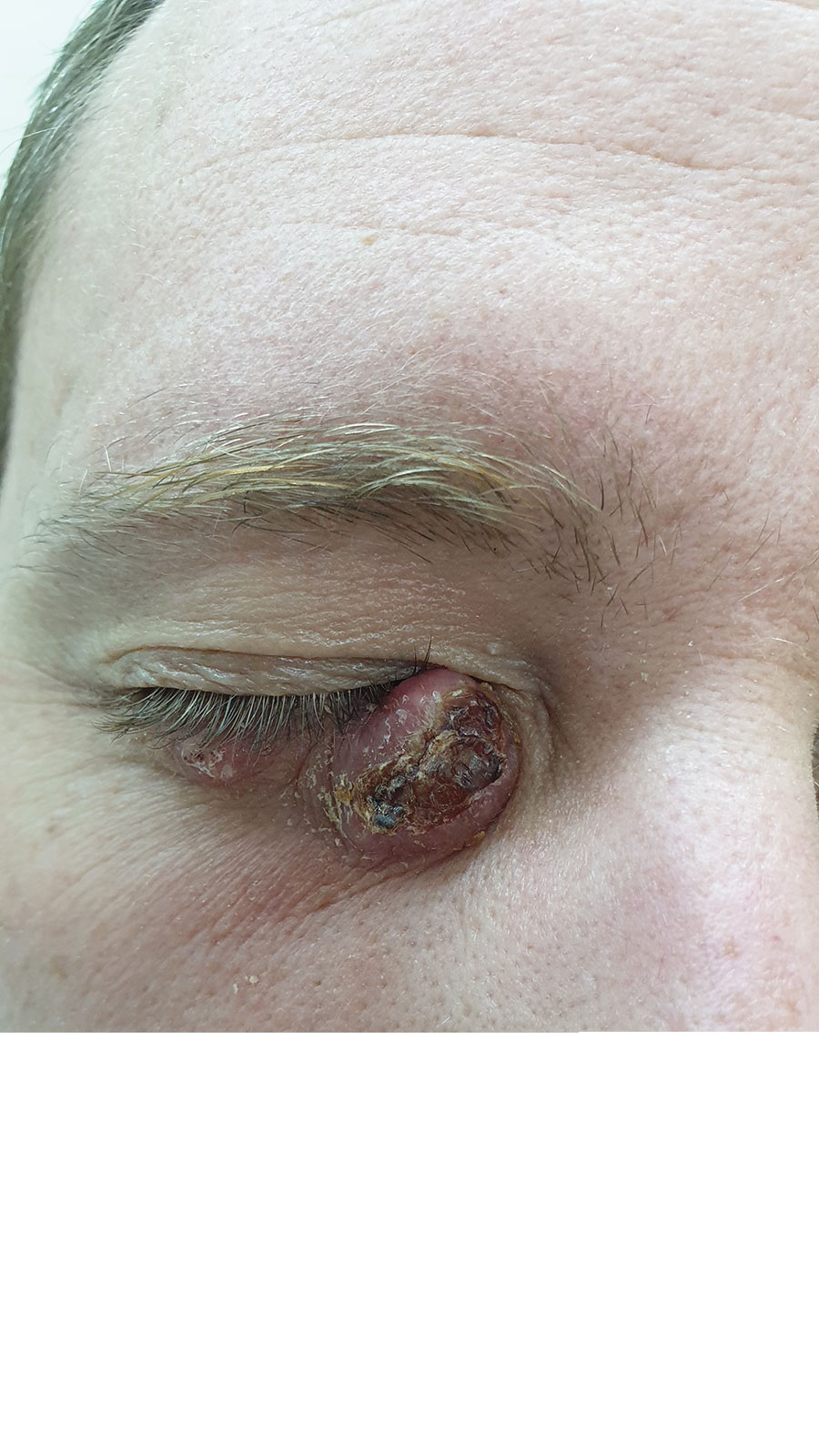 Cutaneous lesion caused by Leishmania infantum on the right lower eyelid of a patient seen at Chaim Sheba Medical Center, Israel, 2021. 